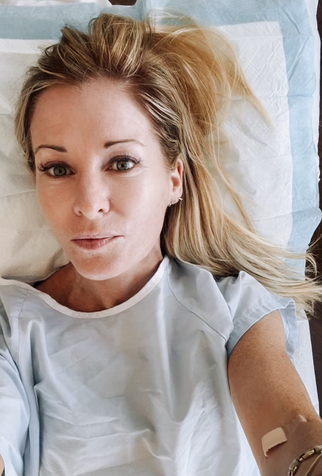 Susie-Wall-Microneedling-with-PRP - Humphrey Dermatology